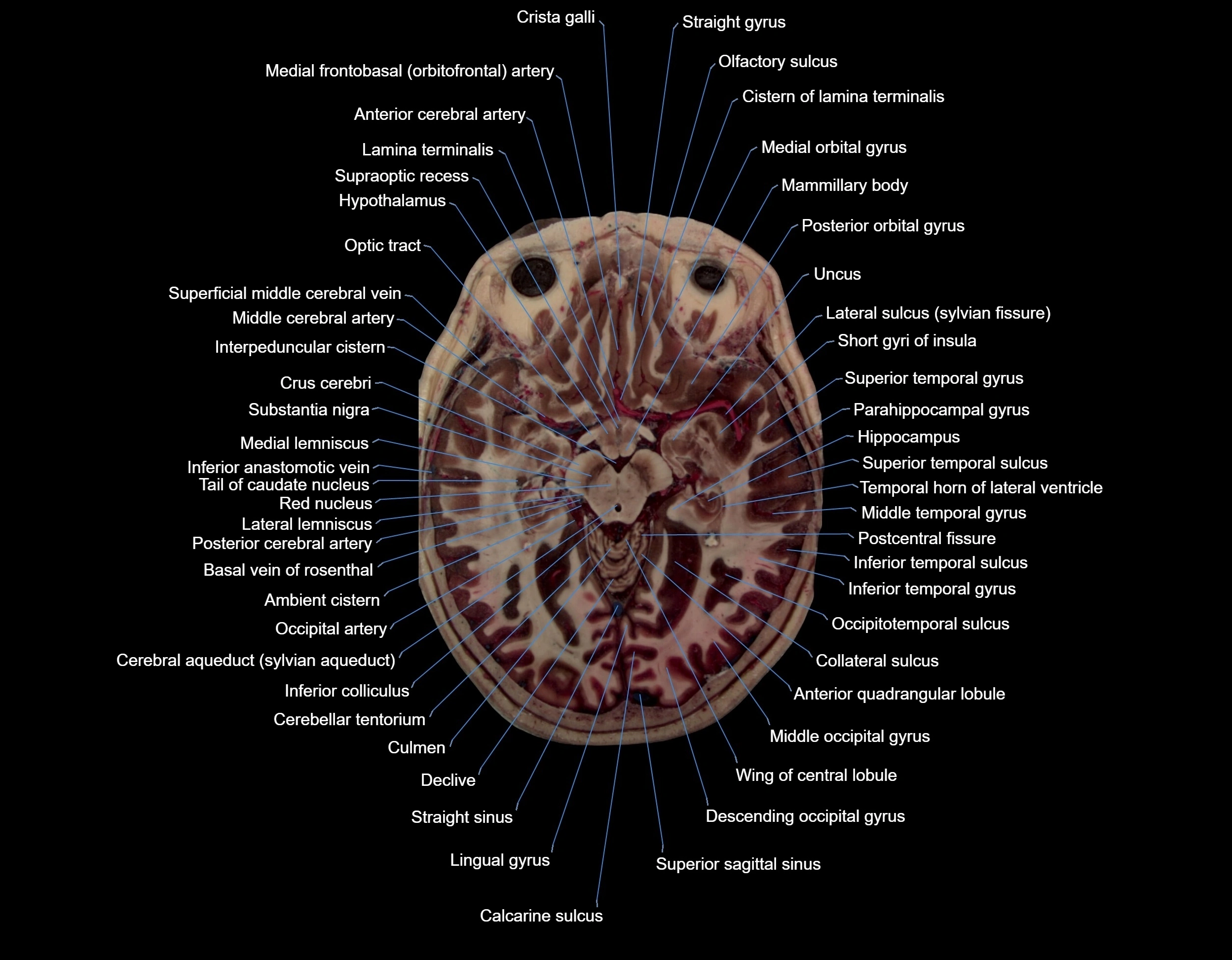 MRI Brain axial cross sectional radiology anatomy 3T image  -img-000036.webp